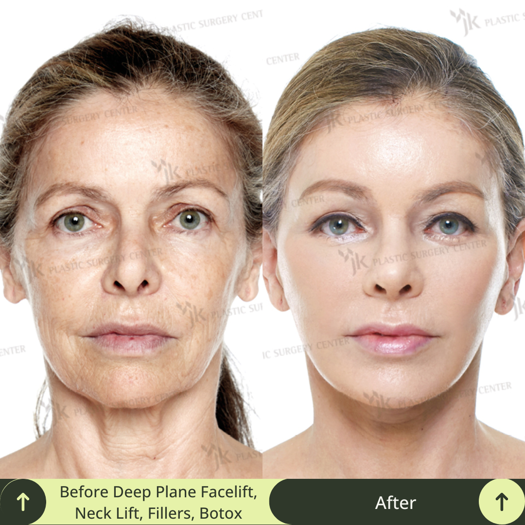 Image of before and after transformation of a middle age women after having a deep plane SMAS face lift and neck lift with fillers and botox , and skin CO2 laser for Australian in South Korea. Glamjet offers beauty medical concierge service for many clients from Australia, the USA, New Zealand, Canada coming to Gangnam, Seoul, South Korea for plastic Surgery. Glamjet connect clients with best  board certified plastic surgeons who are specialist and help clients avoid factory clinics. Medical translation 
