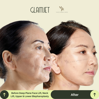 Transformation photo of a client from New Zealand post neck lift and facelift surgery in South Korea with Glamjet.com.au . Results highlight smoother neckline, defined chin, and rejuvenated facial contour. Popular plastic surgery destination for Australians and Kiwis.