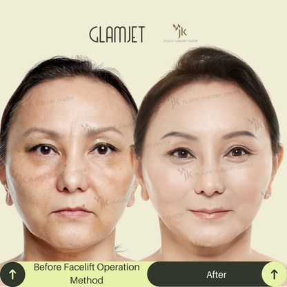 Visible anti-aging results after SMAS facelift and neck lift in South Korea performed on a 55-year-old client. Procedure coordinated by Glamjet.com.au , avoiding factory-style clinics. Ideal for sagging neck skin, jowls, and double chin.