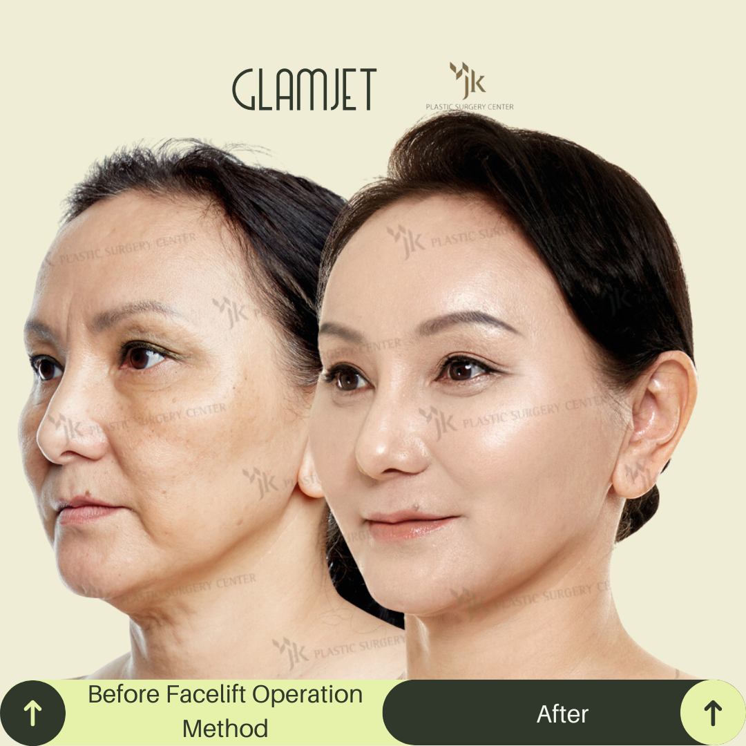 Visible anti-aging results after SMAS facelift and neck lift in South Korea performed on a 55-year-old client by the best neck surgeon in South Korea. Procedure coordinated by Glamjet.com.au, avoiding factory-style clinics. Ideal for sagging neck skin, jowls, and double chin. 