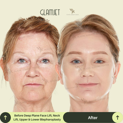 Jawline and neck lift transformation after facial surgery in Gangnam, Seoul. Procedure by a board-certified plastic surgeon matched through Glamjet.com.au , a trusted concierge for Australians seeking the best facelift and neck lift specialists in South Korea.