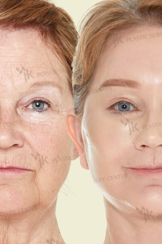 Before and after comparison of a deep plane face and neck lift, blepharoplasty procedure at best surgeon in South Korea for a New Zealand client with Glamjet.com.au