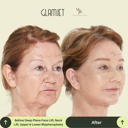 Side profile of a middle-aged client showing youthful contour after a facelift and neck lift performed by one of South Korea’s best plastic surgeons. Glamjet.com.au connects overseas clients with expert anti-aging specialists in Seoul.
