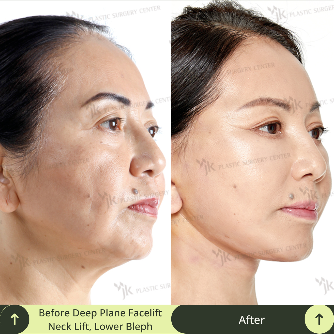 A wonderful transformation achieved for a middle aged women with a deep plane SMAS facelift, neck lift, lower blepharoplasty, and skin treatment in a plastic surgery clinic in Gangnam, Seoul, South Korea. This image demonstrates the high-level expertise of South Korea’s leading board certified plastic surgeons specialised in facelift, neck lift, and eye anti-aging. Glamjet offers exclusive medical concierge service, translation, and payment plans for clients from Australia, New Zealand, and North America. 