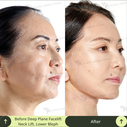 A wonderful transformation achieved for a middle aged women with a deep plane SMAS facelift, neck lift, lower blepharoplasty, and skin treatment in a plastic surgery clinic in Gangnam, Seoul, South Korea. This image demonstrates the high-level expertise of South Korea’s leading board certified plastic surgeons specialised in facelift, neck lift, and eye anti-aging. Glamjet offers exclusive medical concierge service, translation, and payment plans for clients from Australia, New Zealand, and North America. 