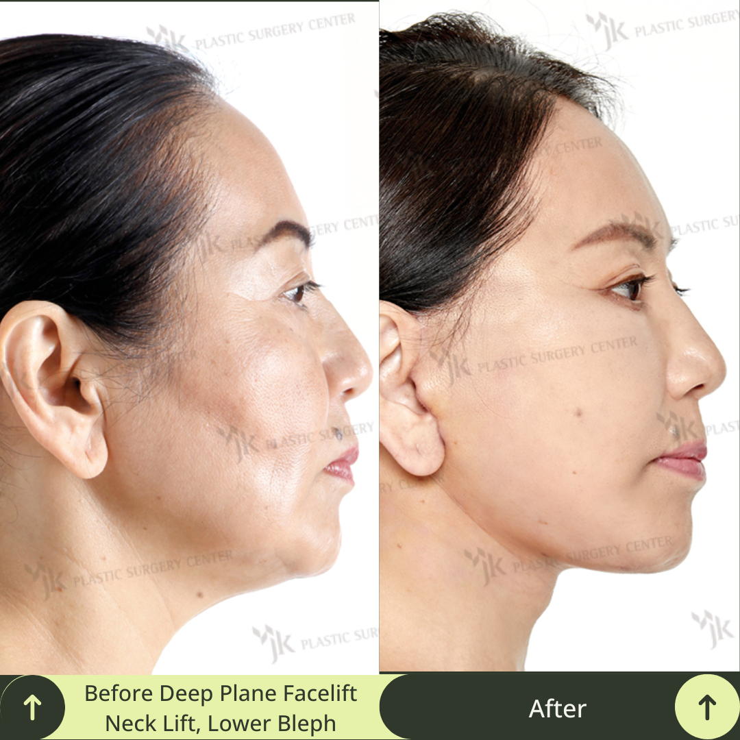 This before-and-after photo illustrates the effectiveness of deep plane SMAS facelift, neck lift, lower blepharoplasty, and skin treatment in a plastic surgery clinic in Gangnam, Seoul, South Korea. It shows the high-level expertise of South Korea’s leading board certified plastic surgeons specialised in facelift, neck lift, and eye anti-aging. Glamjet offers exclusive medical concierge service, translation, and payment plans for clients from Australia, New Zealand, and North America. 
