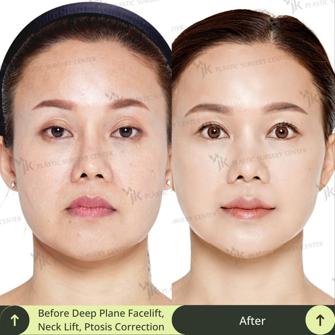 This image shows dramatic results before and after a deep plane SMAS facelift, neck lift, and ptosis correction highlighting the artistry of board-certified plastic surgeons in South Korea. Glamjet caters to clients from Australia, the USA, and beyond, offering bespoke beauty concierge services and unrivalled access to world-class clinics in Gangnam, Seoul, South Korea. 