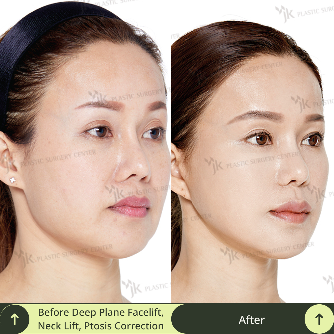 This photo shows before and after a transformative facial rejuvenation surgery of a middle aged women after a deep plane SMAS facelift, neck lift, ptosis eye correction. Glamjet connects clients from Australia, New Zealand, and North America with South Korea’s top-tier surgeons, ensuring a stress-free and personalized aesthetic experience.