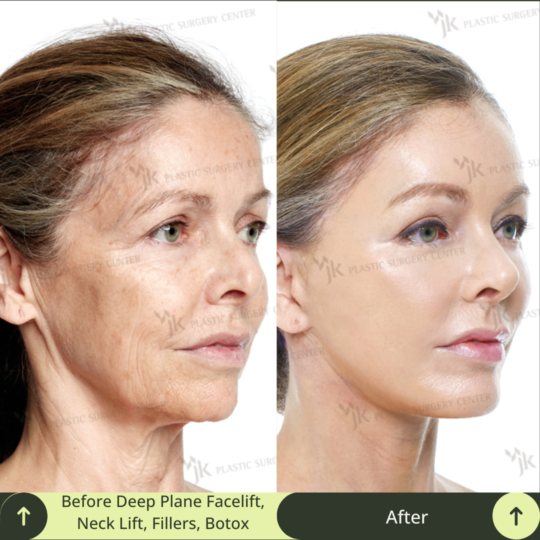 Middle-aged woman’s face transformation after a facelift, neck lift, and skin rejuvenation in Gangnam, Seoul. This image showcases the expertise of South Korea’s top board-certified plastic surgeons. Glamjet provides premium beauty medical concierge services to clients from Australia, the USA, New Zealand, and Canada, helping them access world-class aesthetic procedures in Gangnam, Seoul. Glamjet ensures personalized care, medical translation, and connections with expert surgeons, and avoid factory clinics