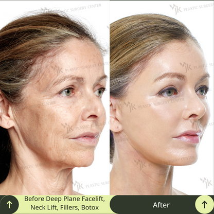 Middle-aged woman’s face transformation after a facelift, neck lift, and skin rejuvenation in Gangnam, Seoul. This image showcases the expertise of South Korea’s top board-certified plastic surgeons. Glamjet provides premium beauty medical concierge services to clients from Australia, the USA, New Zealand, and Canada, helping them access world-class aesthetic procedures in Gangnam, Seoul. Glamjet ensures personalized care, medical translation, and connections with expert surgeons, and avoid factory clinics