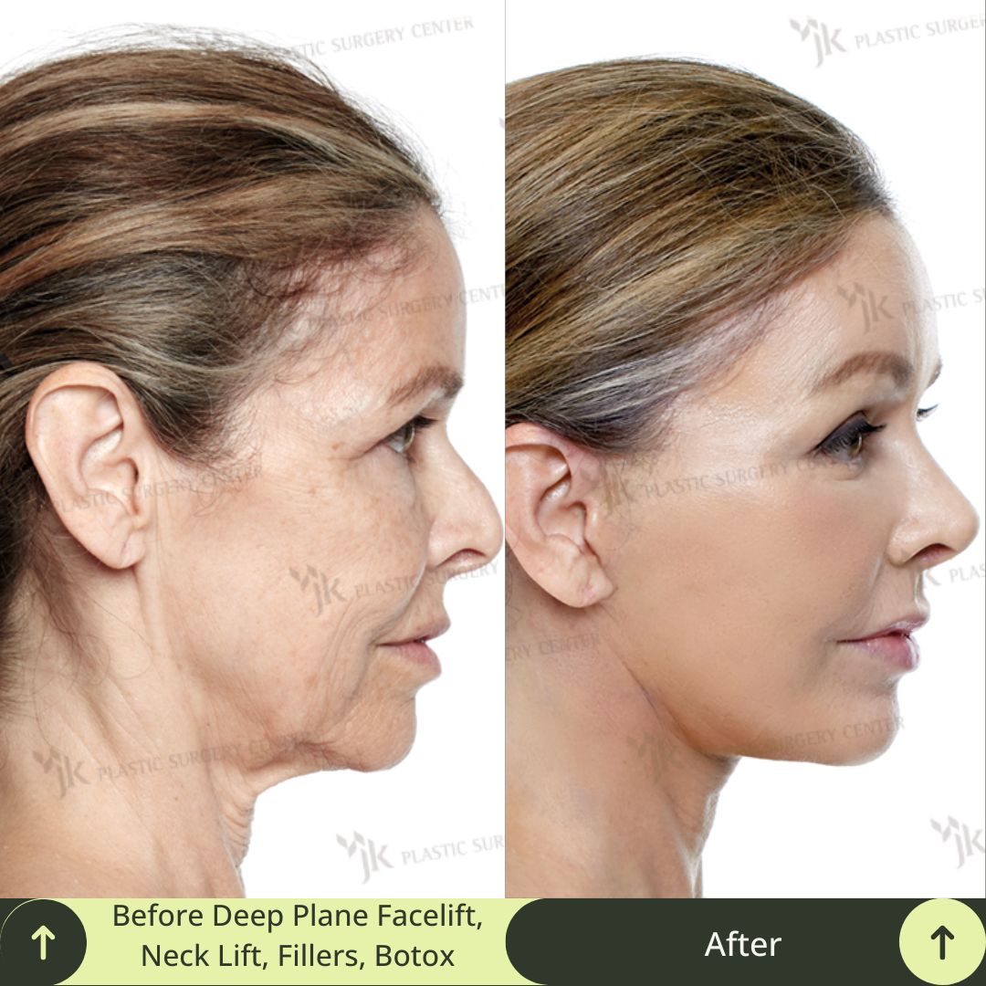 Facial rejuvenation results from a deep plane SMAS facelift, neck lift, and advanced skin treatments in Gangnam, South Korea.South Korea’s elite board-certified plastic surgeons in Gangnam deliver exceptional results. Glamjet connects clients from Australia, the USA, New Zealand, and Canada with best plastic surgery clinic in Gangnam, South Korea, offering medical concierge service, expert medical translation, and payment plans