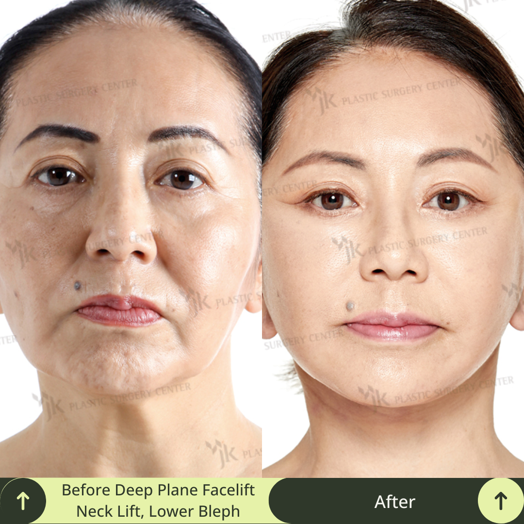 A stunning transformation achieved with a deep plane SMAS facelift, neck lift, lower blepharoplasty, and skin treatment in a plastic surgery clinic in Gangnam, Seoul, South Korea. This image demonstrates the high-level expertise of South Korea’s leading board certified plastic surgeons specialised in facelift, neck lift, and eye anti-aging. Glamjet offers exclusive medical concierge services for clients from Australia, New Zealand, and North America, ensuring seamless, high-quality aesthetic journeys.