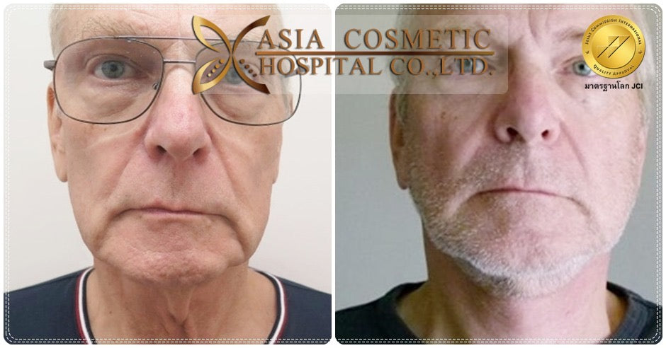 Men Face Lift Packages in Thailand