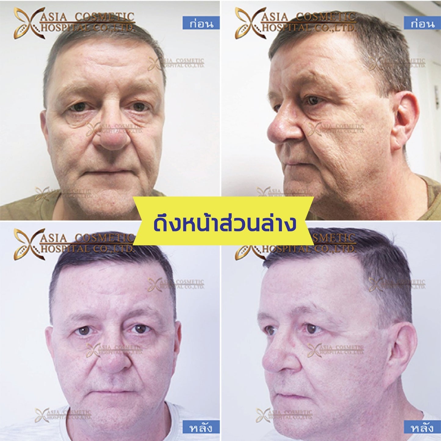 Men Face Lift Packages in Thailand