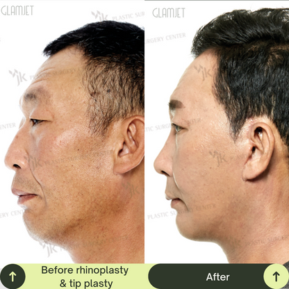 Men Rhinoplasty Surgery Packages In South Korea