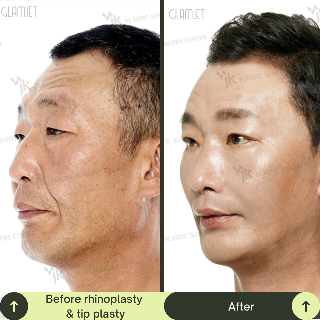 Men Rhinoplasty Surgery Packages In South Korea