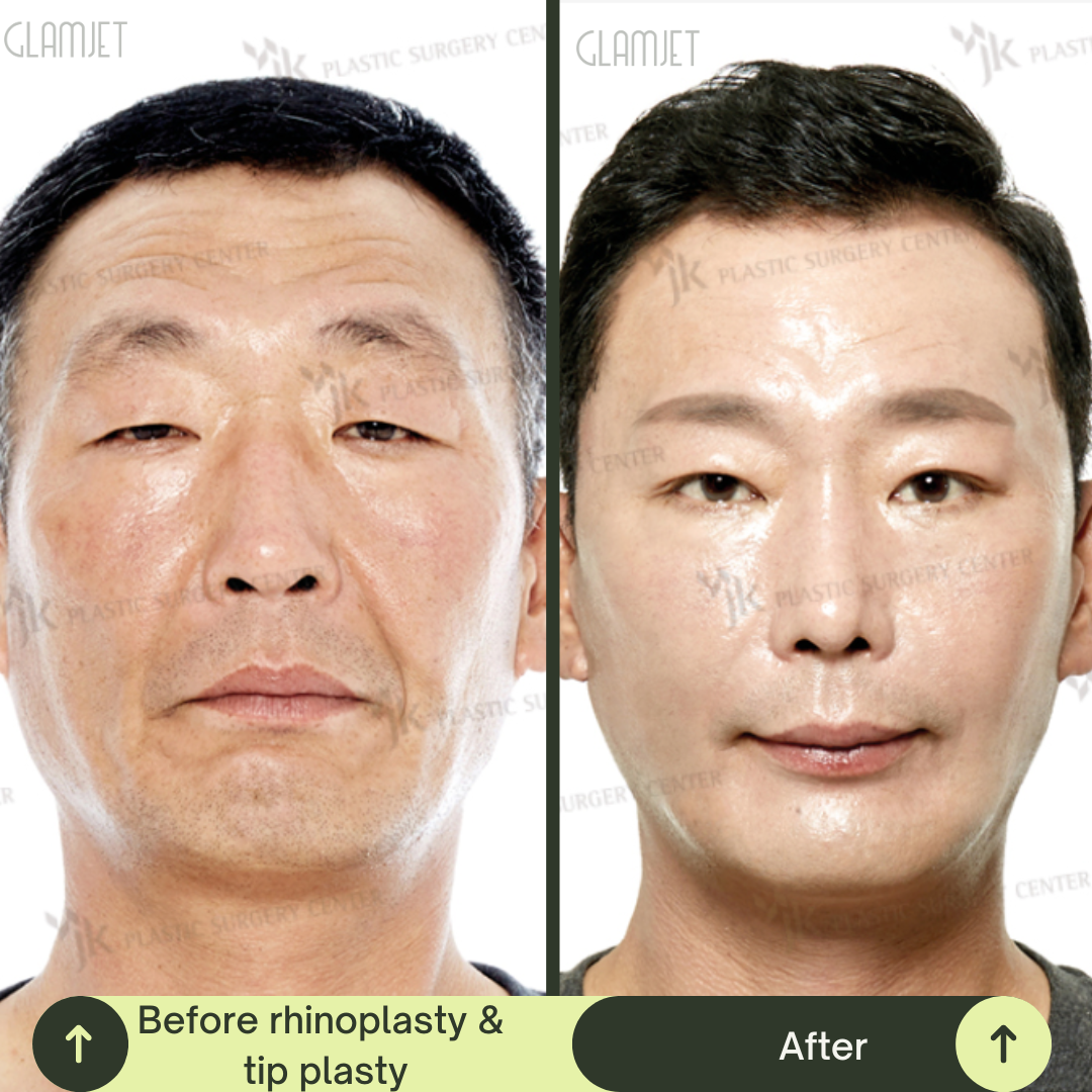 Men Rhinoplasty Surgery Packages In South Korea