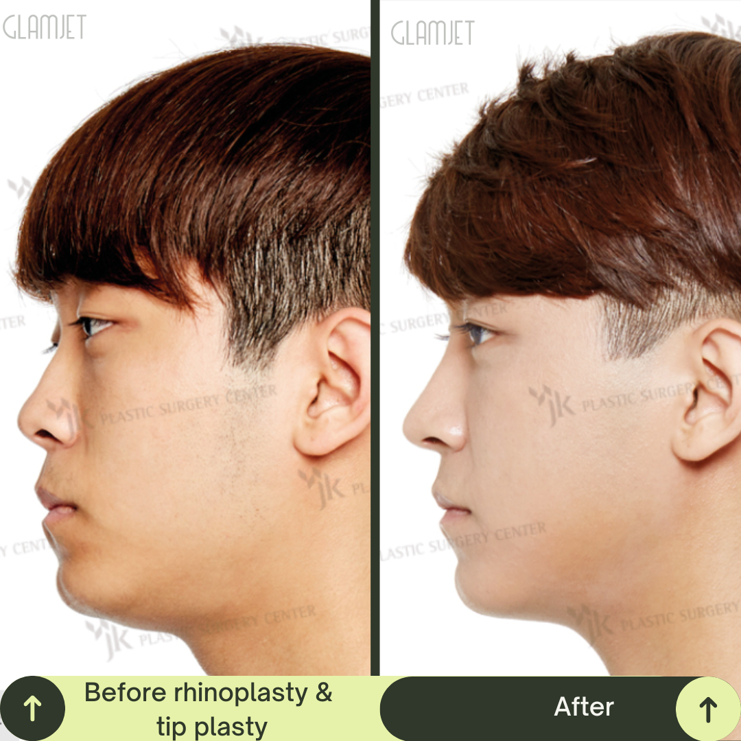 Men Rhinoplasty Surgery Packages In South Korea