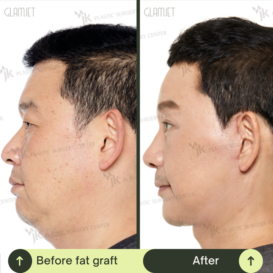 Men Rhinoplasty Surgery Packages In South Korea