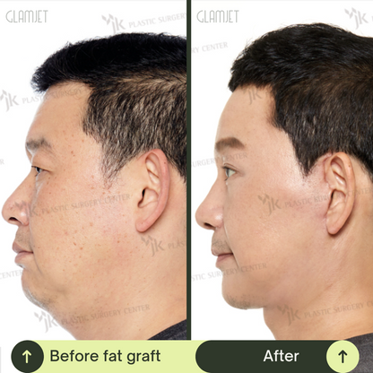Men Rhinoplasty Surgery Packages In South Korea
