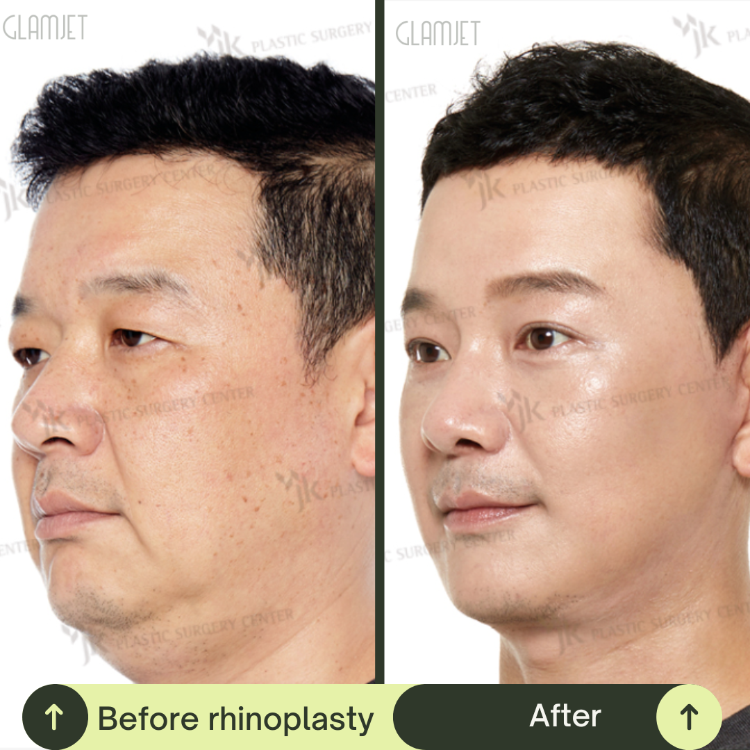 Men Rhinoplasty Surgery Packages In South Korea