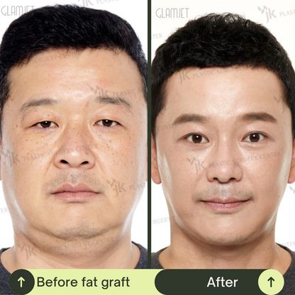 Men Rhinoplasty Surgery Packages In South Korea