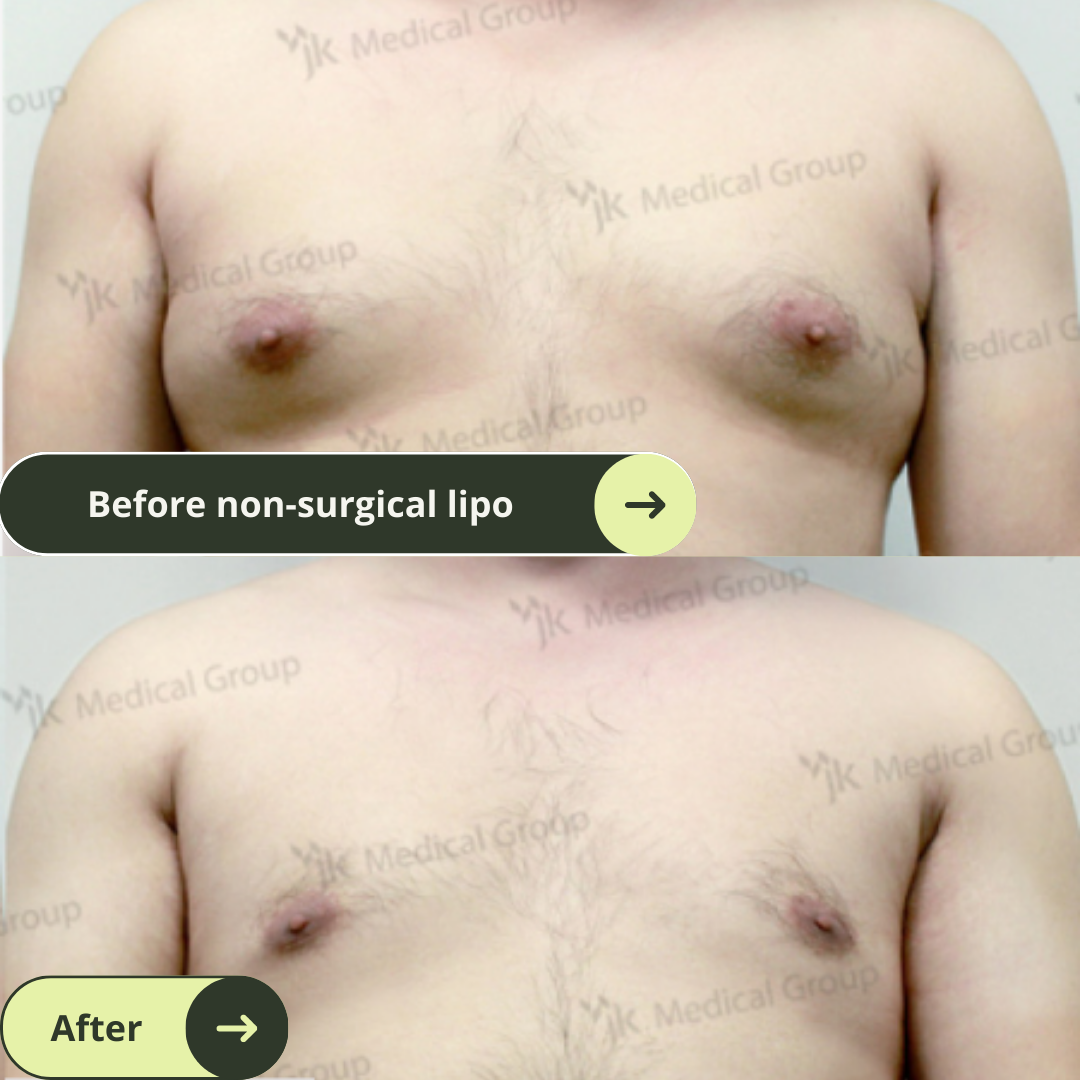 Men Gynaecomastia (Breast Surgery) Packages In South Korea