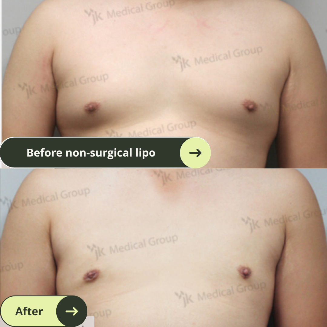 Men Gynaecomastia (Breast Surgery) Packages In South Korea