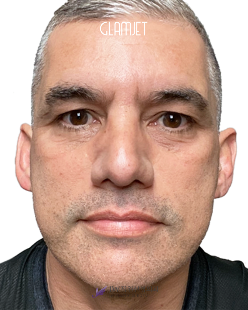 After - Dr. Man: Reduction rhinoplasty with bulbous tip correction and alar base reduction