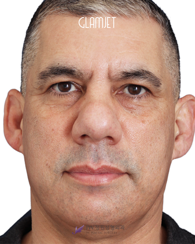 Before - Dr. Man: Reduction rhinoplasty with bulbous tip correction and alar base reduction