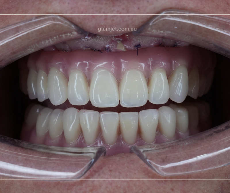 After - Case 3 - Before and after  all-on-6 implants for upper jaw and all-on-4 dental implants for lower jaw in Vietnam