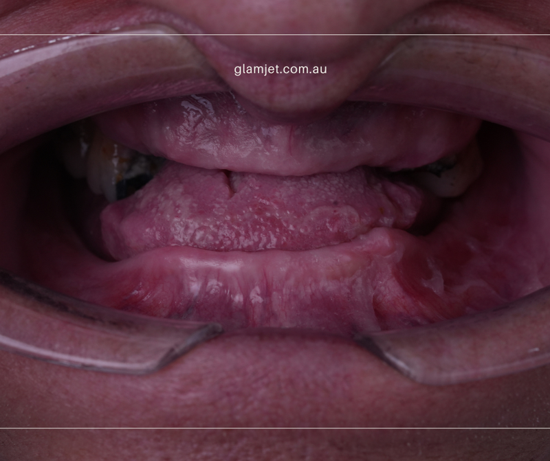 Before - Case 3 - Before and after  all-on-6 implants for upper jaw and all-on-4 dental implants for lower jaw in Vietnam