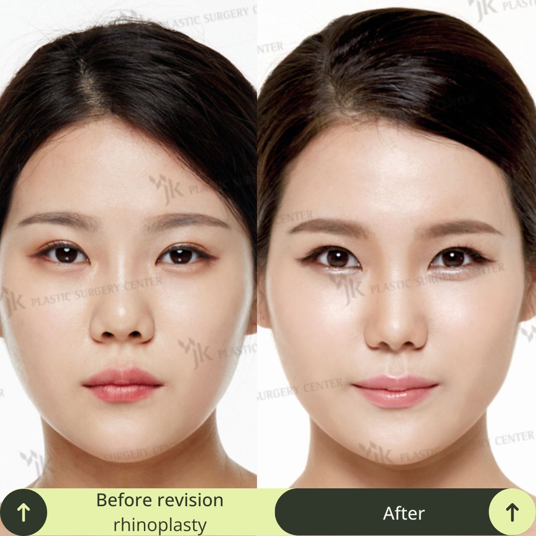 Women Rhinoplasty Surgery Packages In South Korea