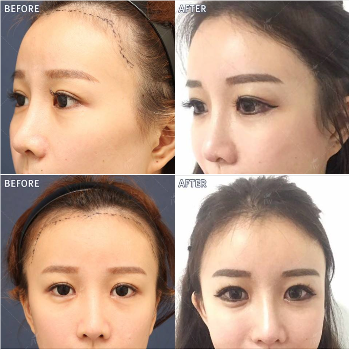 Hair Transplant Packages In South Korea