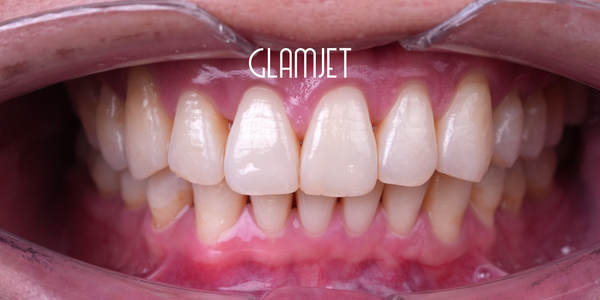 LiSi/Lumineers Veneer