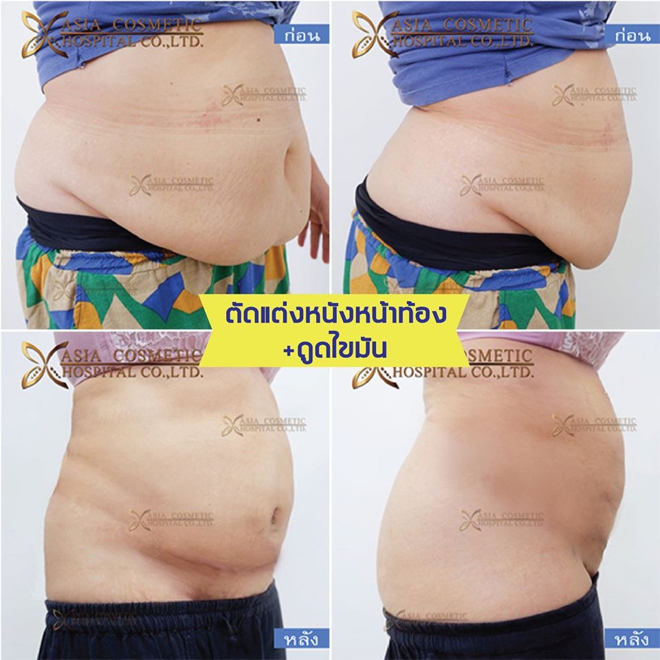 Mommy Makeover Packages In Thailand