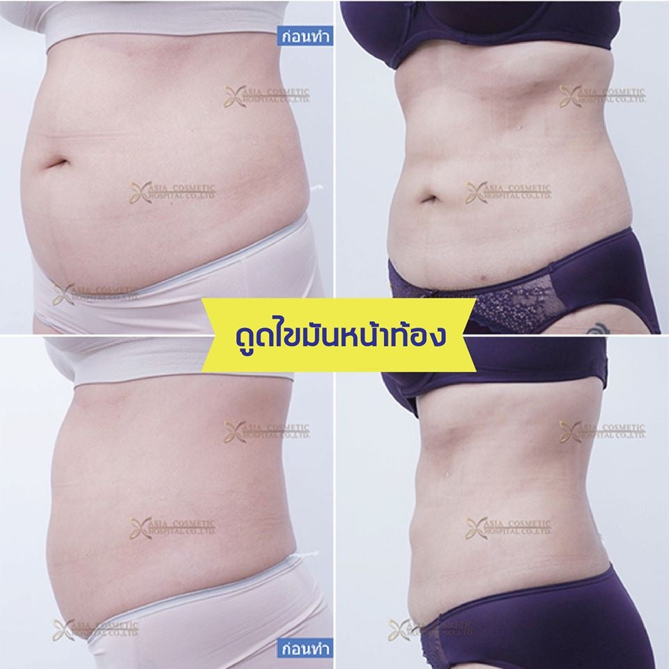 Mommy Makeover Packages In Thailand