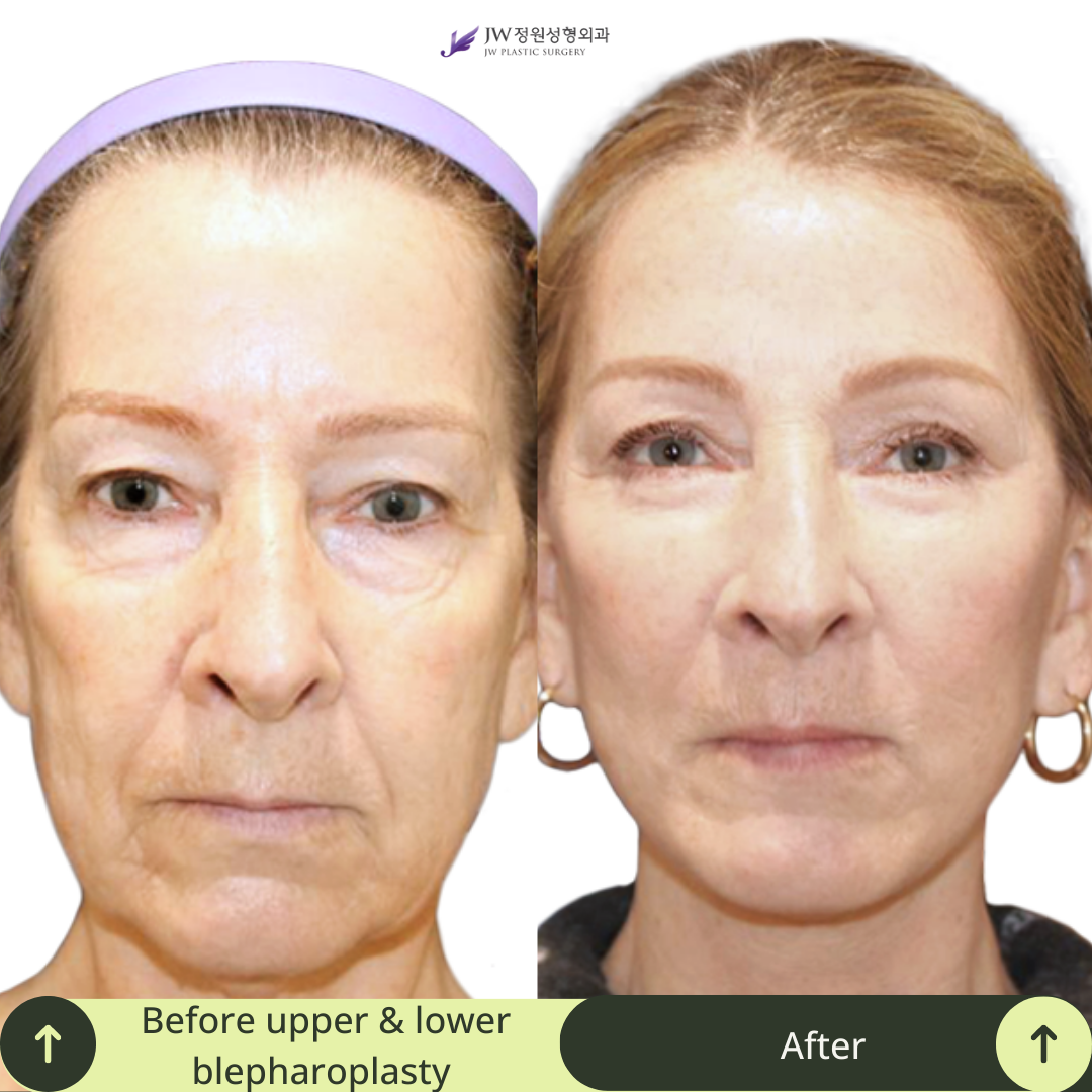 Upper Blepharoplasty Surgery Packages in South Korea