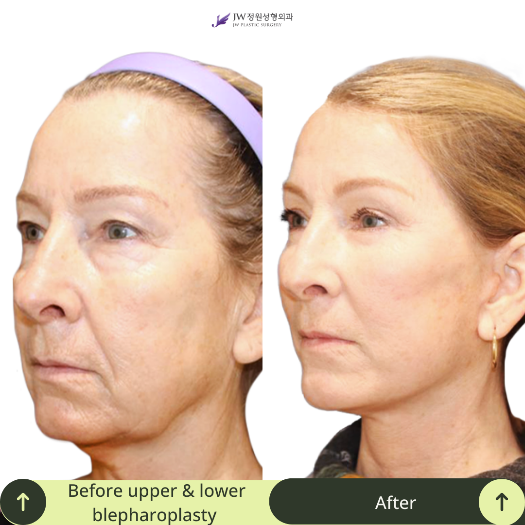 Upper Blepharoplasty Surgery Packages in South Korea