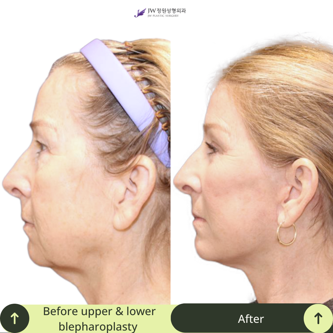 Upper Blepharoplasty Surgery Packages in South Korea