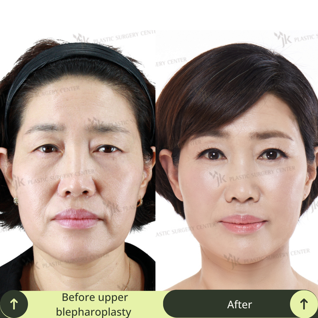 Upper Blepharoplasty Surgery Packages in South Korea