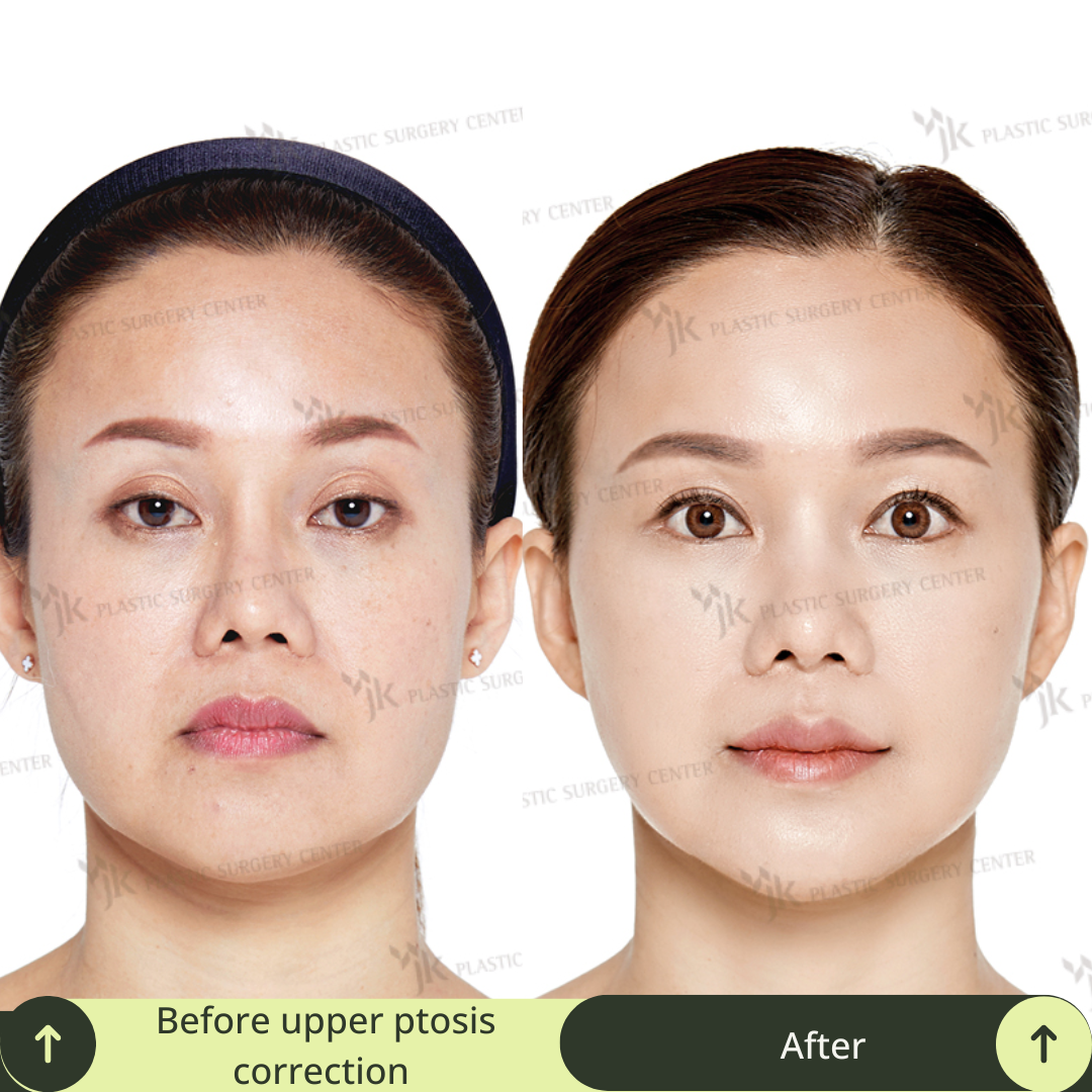 Upper Blepharoplasty Surgery Packages in South Korea