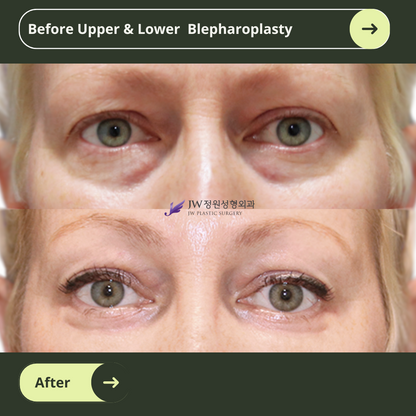 Upper Blepharoplasty Surgery Packages in South Korea