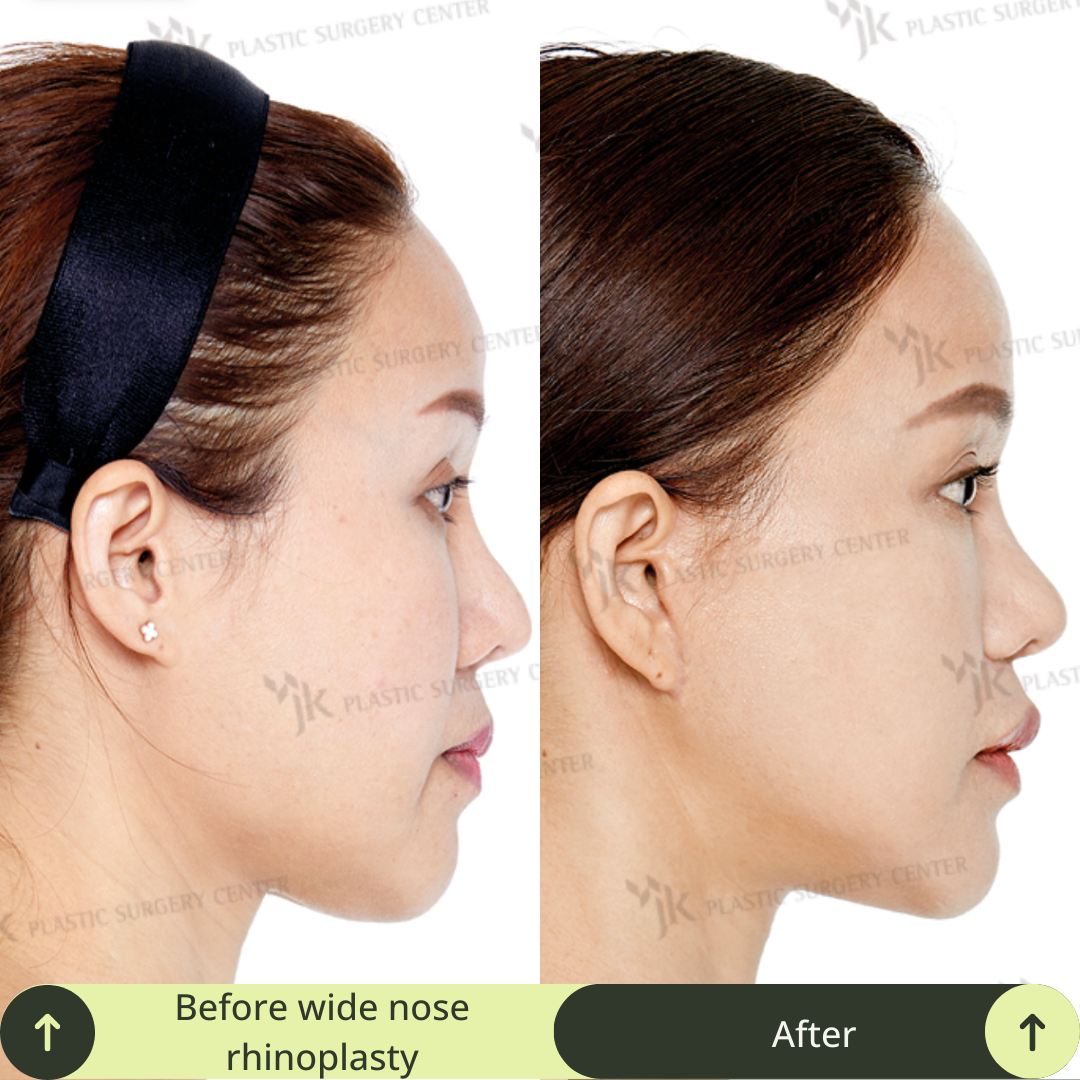 Women Rhinoplasty Surgery Packages In South Korea