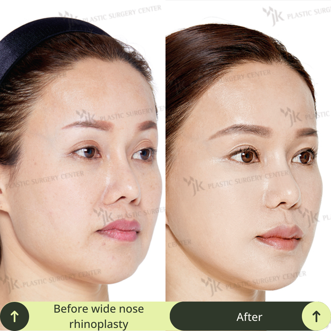 Women Rhinoplasty Surgery Packages In South Korea