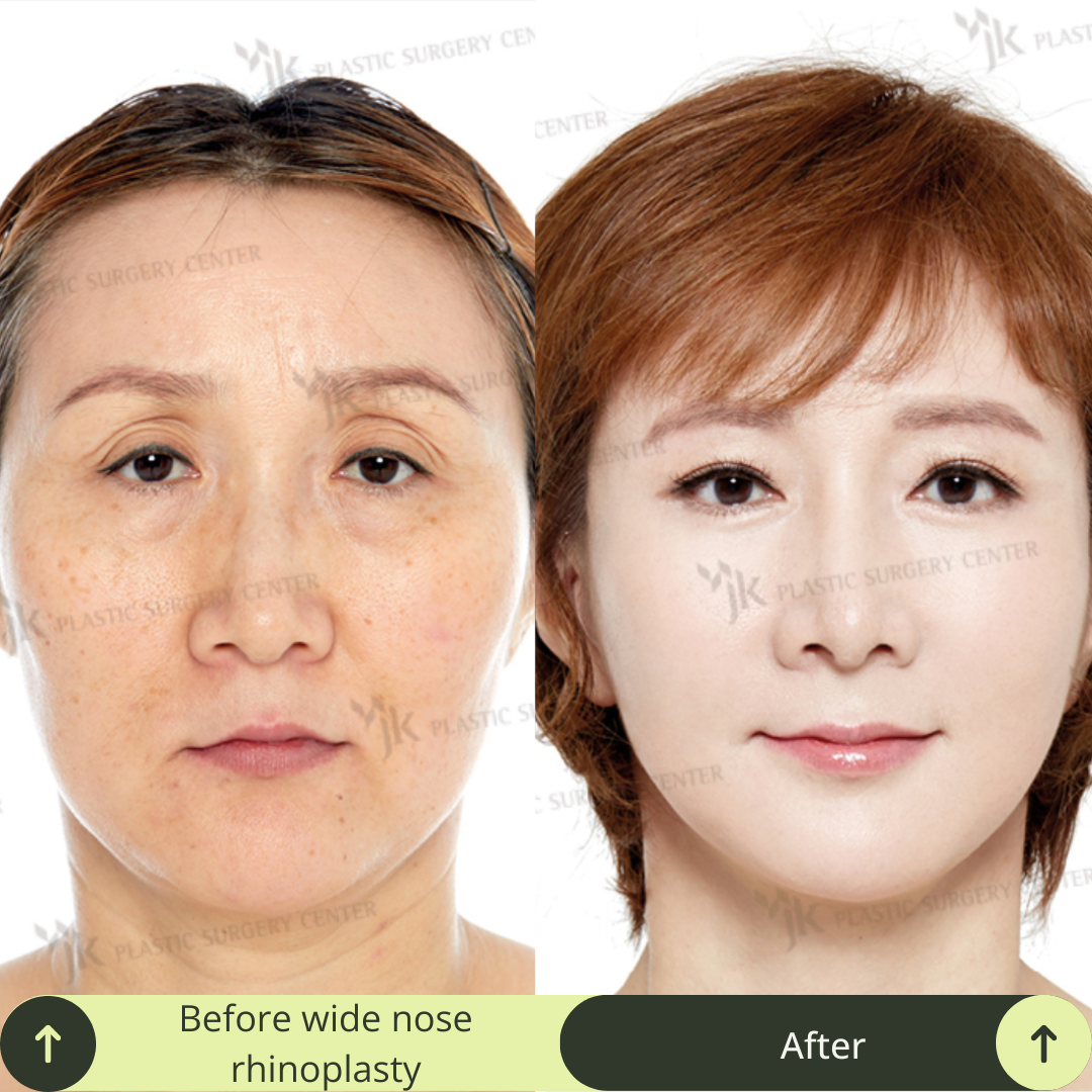 Women Rhinoplasty Surgery Packages In South Korea