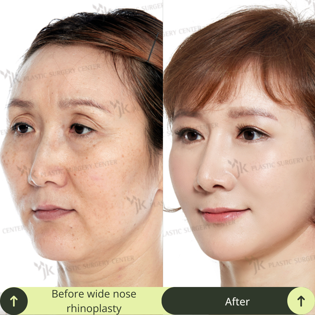 Women Rhinoplasty Surgery Packages In South Korea