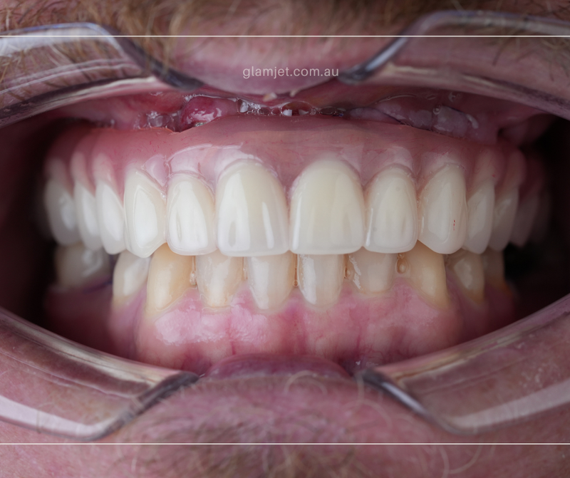After - Case 4 - Australian patient before and after all-on-6 implants for top jaw in Vietnam