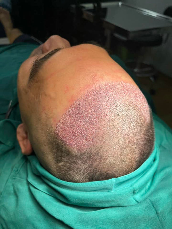 What is hair transplant?