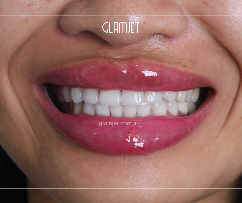 After - Case 6: 16 Emax veneers
